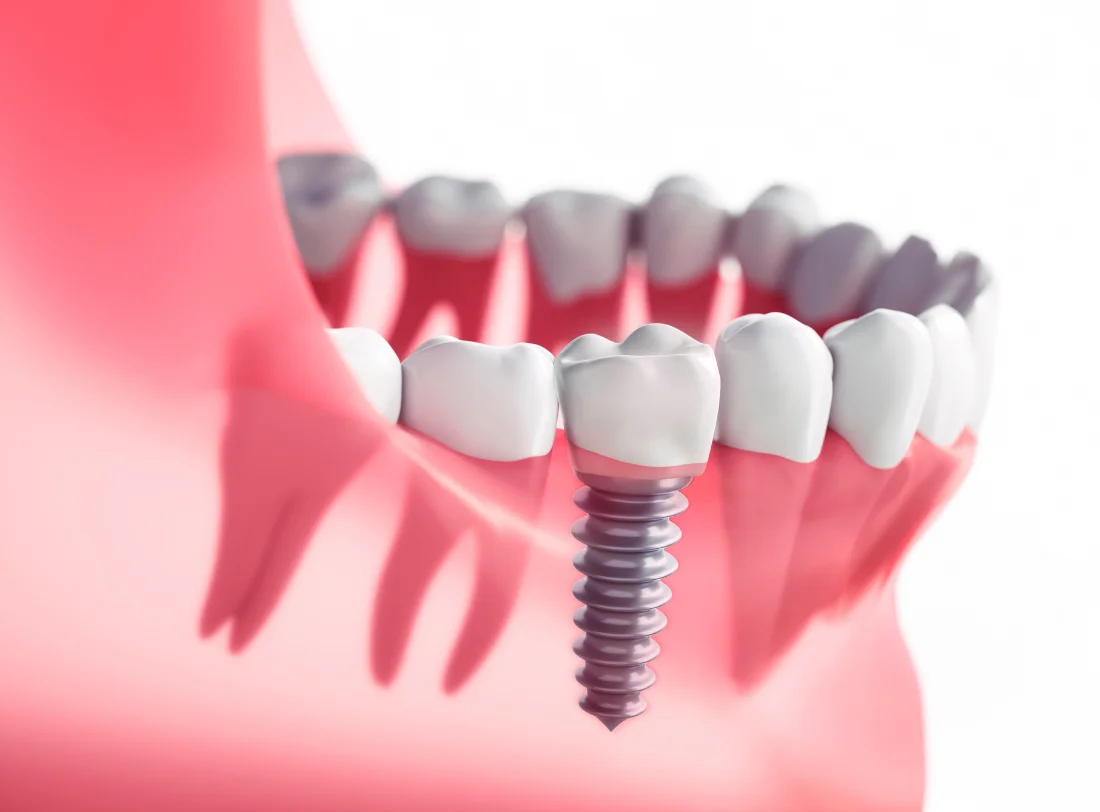 Dental Implants Pimlico Victoria London Dentist Offers Consultations at McKennell Dental Practice