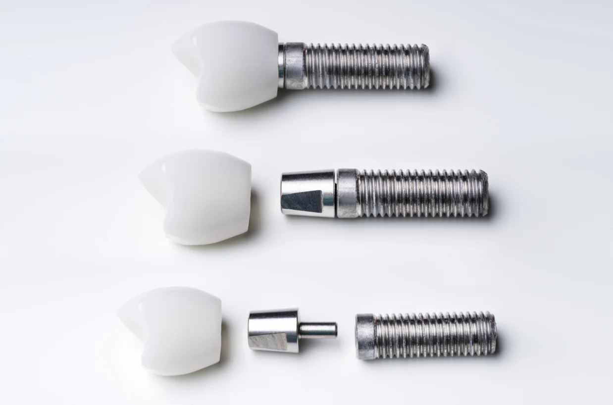 Bromley Dental Implants Dentist Announces Consultations at Smile 4 U Dental Practice